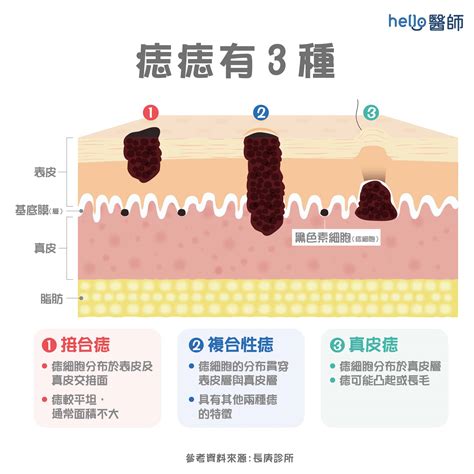 身體多痣|痣變大、痣多或長毛會變皮膚癌？認識痣的形成與原因